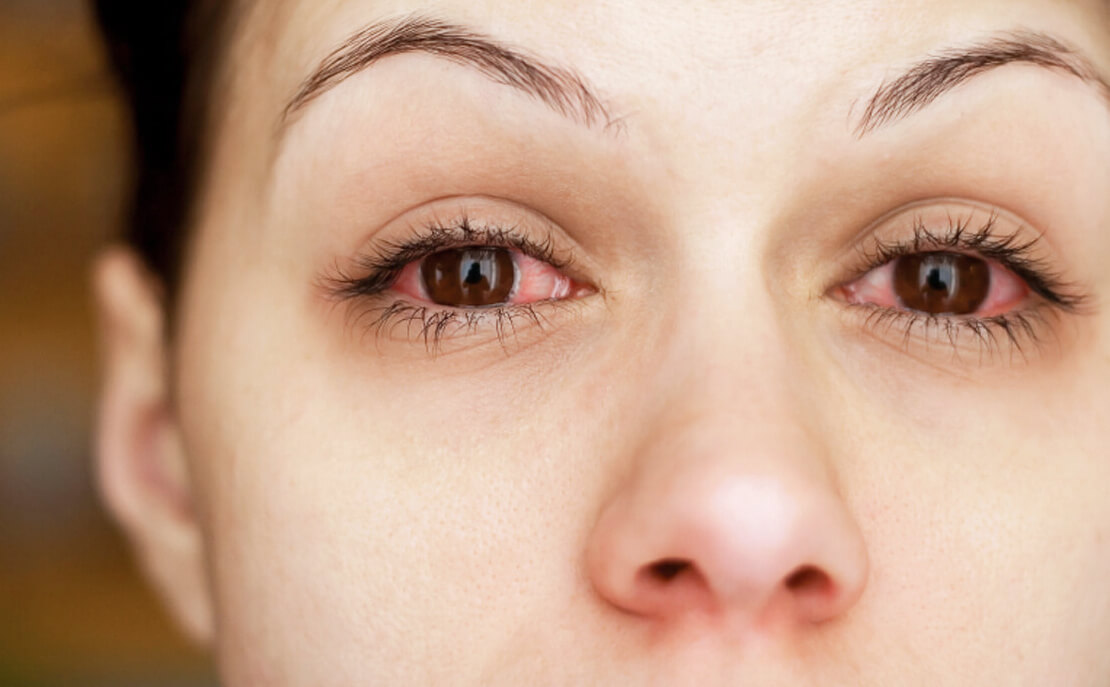 Аллергия на клей для наращивания